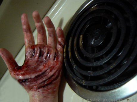 Stove_burn_by_Guirnou